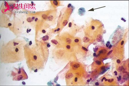 食疗调理击退女性滴虫阴道炎