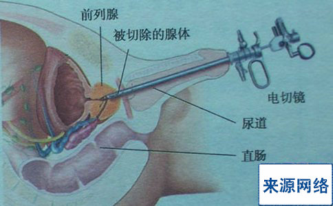 前列腺增生危害大 多吃大葱和大蒜