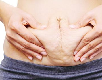 女性产后妊娠纹去除的七个方法