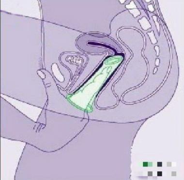 360度演示女用避孕套使用方法（全图）5