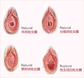 健康女性处女膜变化过程（图）2