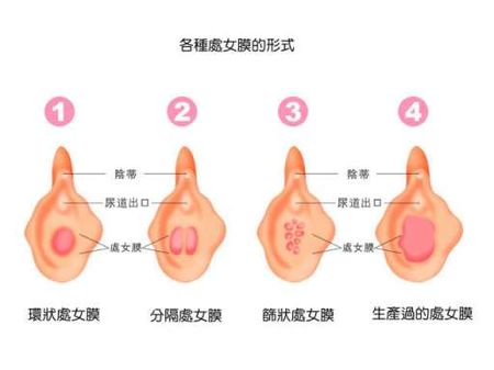 健康女性处女膜变化过程（图）3