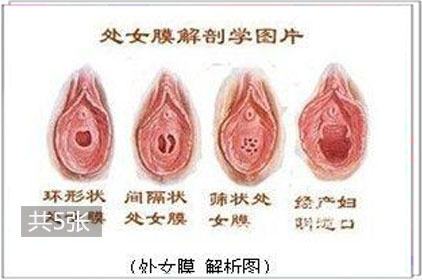 记录生殖器内部处女膜的成长全过程1
