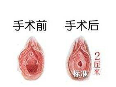 神奇！贯穿女人一生处女膜的三个变化(组图)3