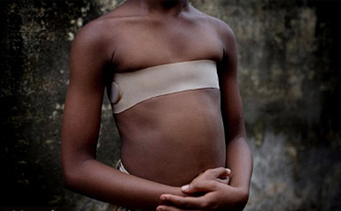 非洲少女胸部被熨平 避免遭性侵