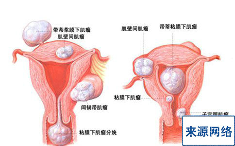 盆腔炎有哪些症状表现