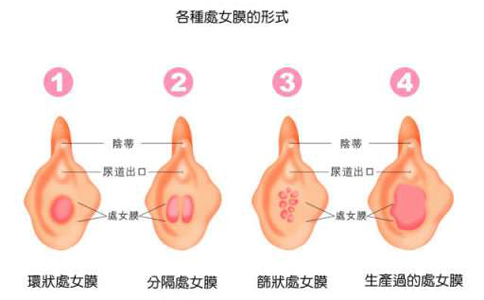 处女膜在阴道哪个位置？看图可知具体位置