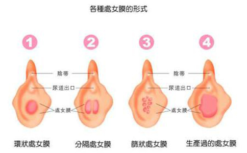 详解处女膜的位置，分析肉眼是否能看到处女膜