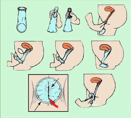 图解：女用避孕套的正确使用方法
