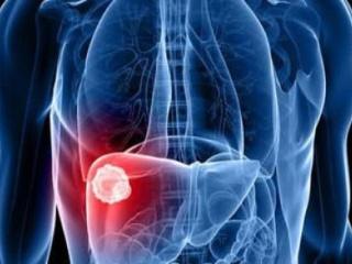 害怕肝癌一定要及时为肝脏解压，肝脏解压5个小妙招